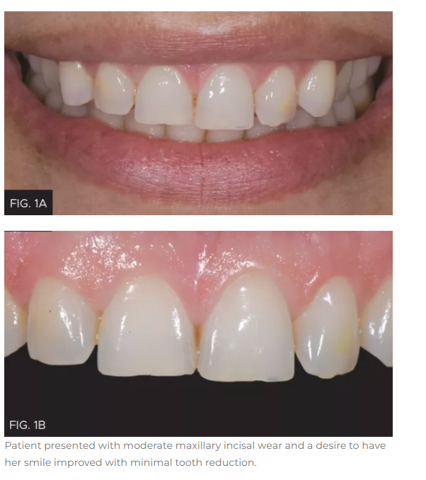 News.Smile Enhancement in the Era of Minimal Tooth Reduction
