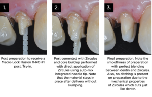 Clinician's Choice Zircules Zirconia Nano-Filled Core Material Clinical Technique