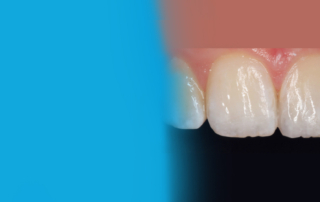 Before using Evanesce Nano-Enhanced Universal Restorative