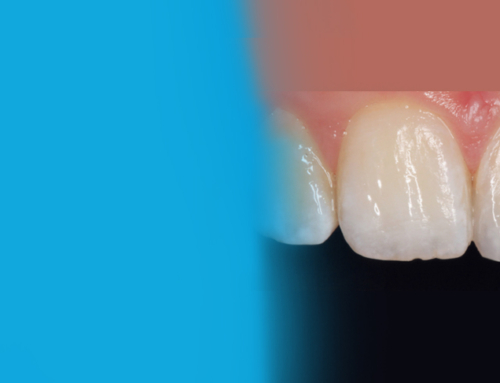 Take Your Restorations to the Next Level With Evanesce