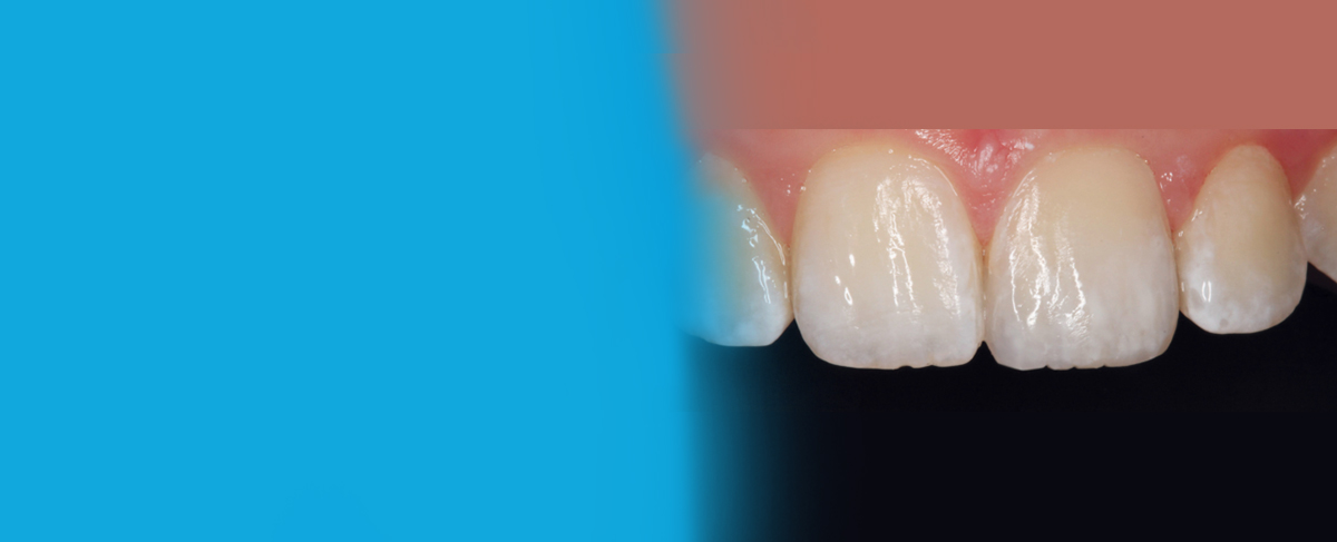 Before using Evanesce Nano-Enhanced Universal Restorative