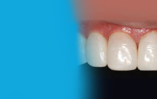 Direct Composite Veneers vs. Porcelain