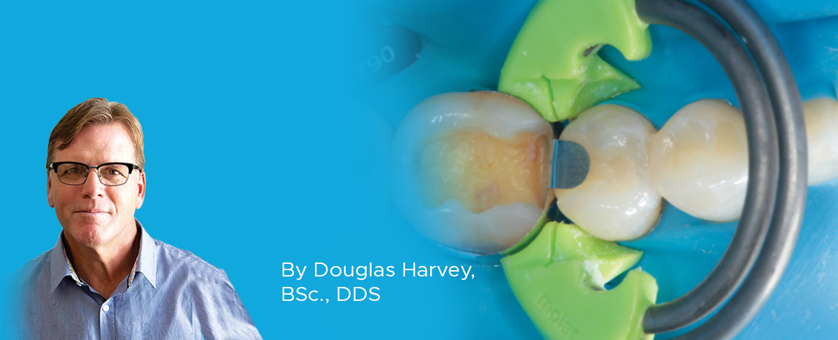 Clinical Article on Sectional Matrix System