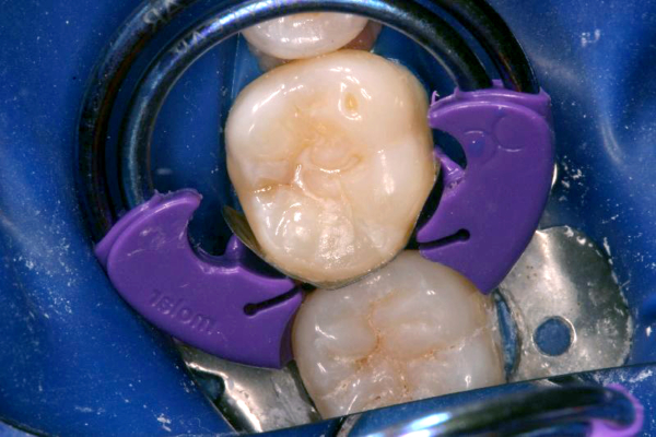 Figure 6: Proceed with placement and light-curing of the composite. A bulk-fill composite was used in this case.