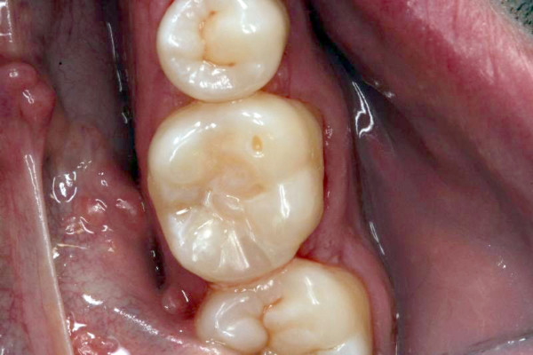 Figure 9: The final restoration: a combination of life-like esthetics and a strong, enduring dentin/enamel bond.