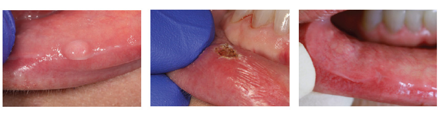 Destruction of a Lesion with Blue Soft Tissue Diode laser