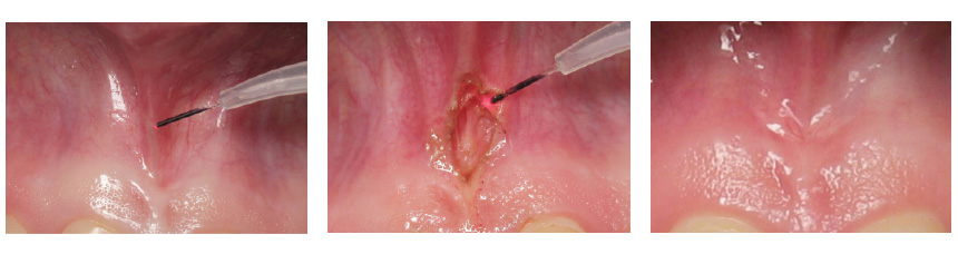 Frenectomy with Blue Soft Tissue Diode laser