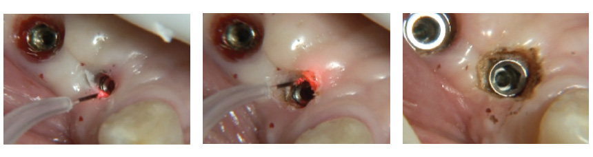 Implant Recovery with Blue Soft Tissue Diode laser