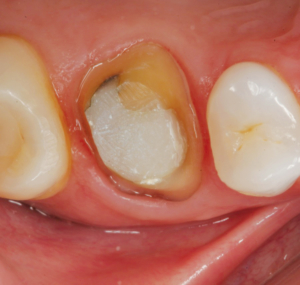 When you are ready, Cling2 releases and usually stays in the prosthesis making clean up a breeze. The remaining Cling2 on preparation flakes off easily.