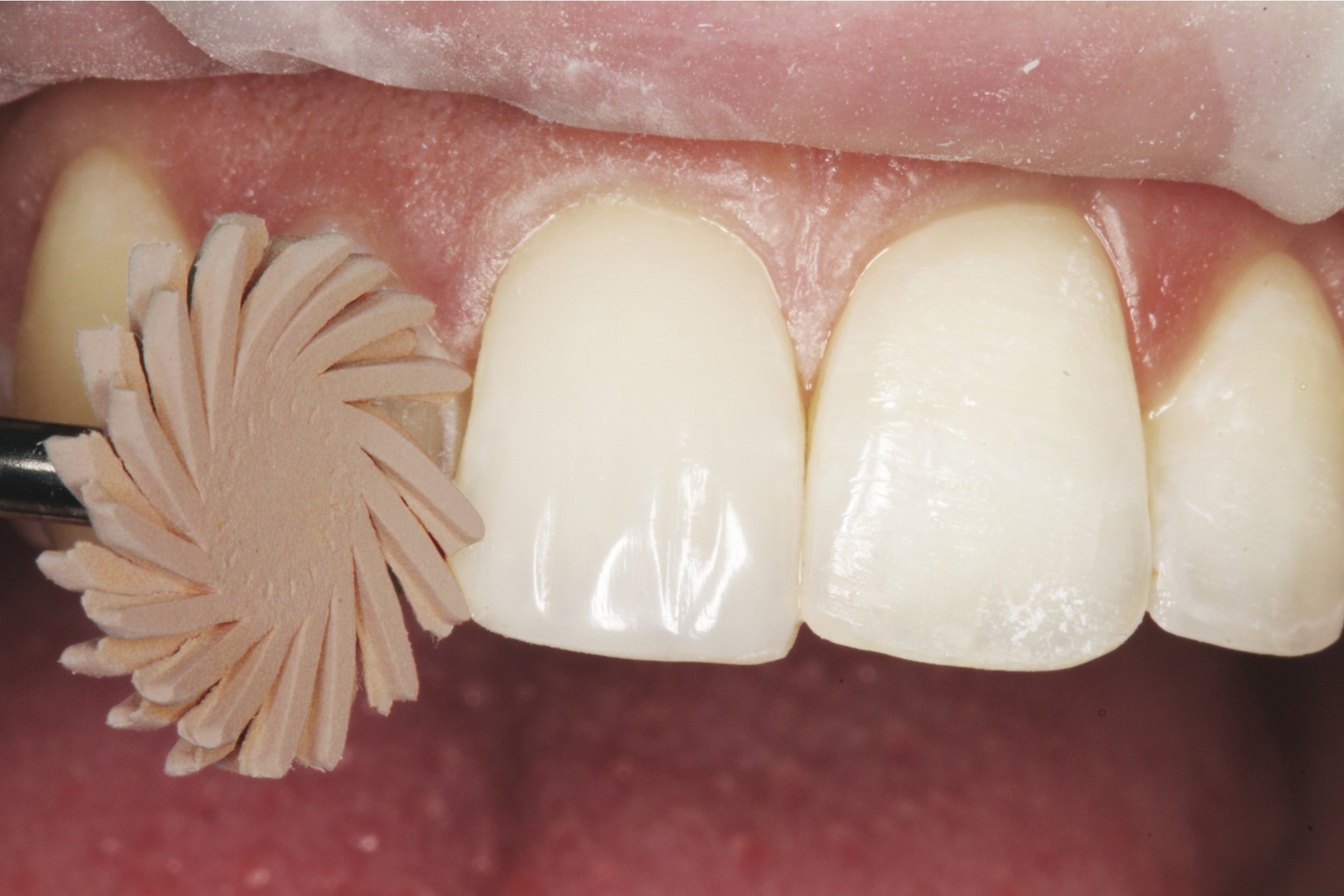 Improve the Overall Quality of your Composite Restorations Clinician