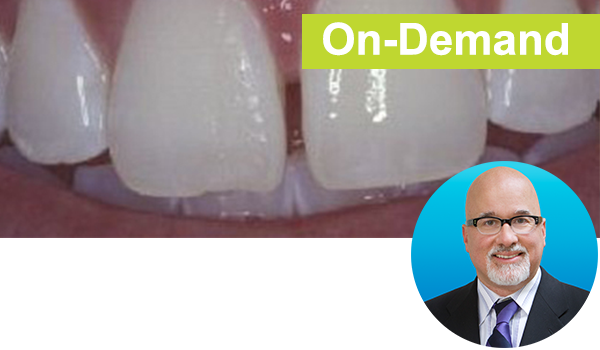 Diastema-OnDemand-ONLY