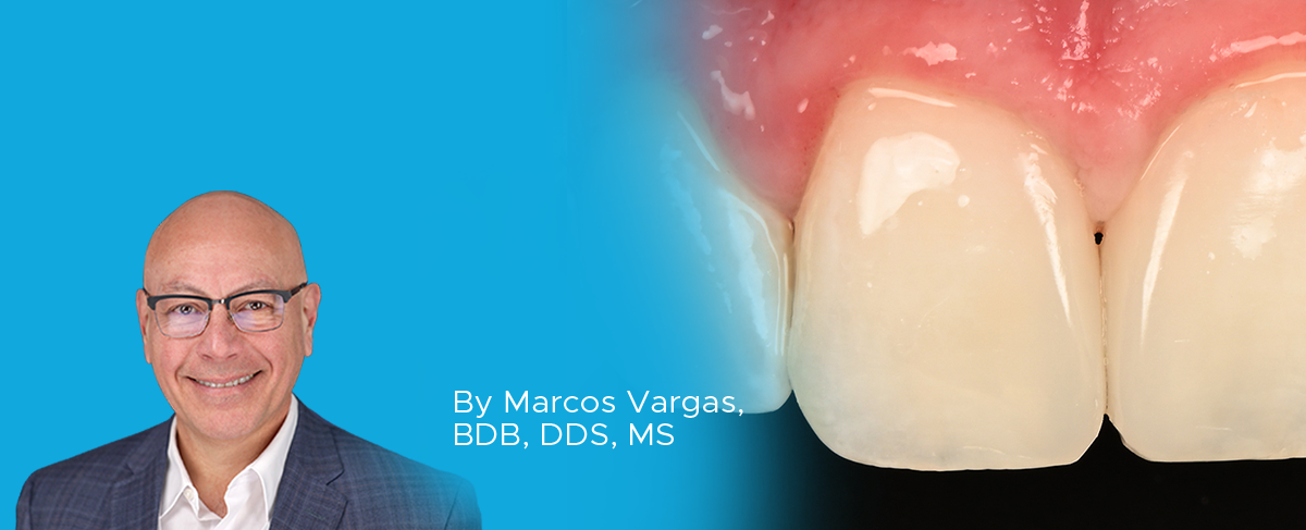 Clinical Article on Non-VITA Shades for Diastema Closure