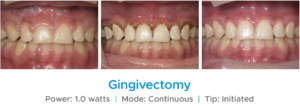 Clinical Images of Gingivectomy with Dental Diode Laser