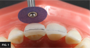 primary anatomy outlined on tooth