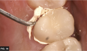 Cling2 excess easily removed with curette