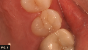 clinical of crack on mesial marginal ridge