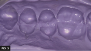 pre-operative impression with Template