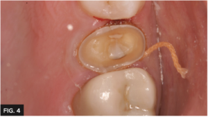 gingival retraction with double cord technique