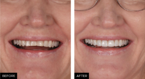 Dr. Bowes Single Opacity article - BEFORE AFTER