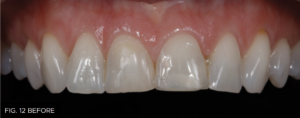 Dr. Bowes Single Opacity article - FIG 12 BEFORE