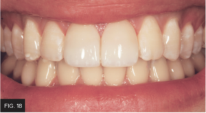 Dr. Chan article Predictable Results Anterior Composites - FIG 18