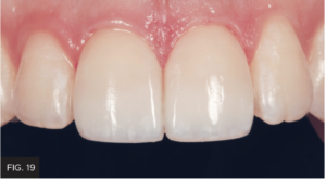 Dr. Chan article Predictable Results Anterior Composites - FIG 19