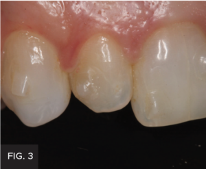 Dr. Larose lateral incisor article - FIG 3