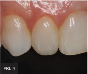 Dr. Larose lateral incisor article - FIG 4