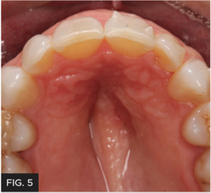 Dr. Larose lateral incisor article - FIG 5