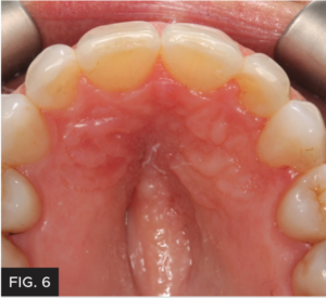 Dr. Larose lateral incisor article - FIG 6