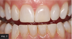 Dr. Larose lateral incisor article - FIG 7