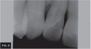 Dr. Larose lateral incisor article - FIG 9