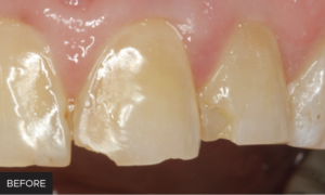 Dr. Lawson Anterior Restorations article - BEFORE