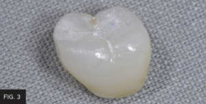 Dr. Peck Ceramic Polishing article - FIG 3