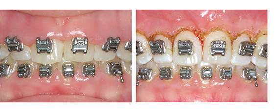 Hyperplasia with Blue Soft Tissue Diode laser