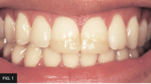 Dr. Chan article Predictable Results Anterior Composites - FIG 1