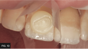 Dr. Chan article Predictable Results Anterior Composites - FIG 10