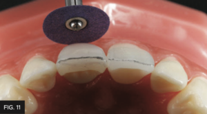 Dr. Chan article Predictable Results Anterior Composites - FIG 11