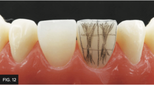 Dr. Chan article Predictable Results Anterior Composites - FIG 12