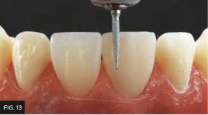 Dr. Chan article Predictable Results Anterior Composites - FIG 13