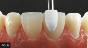 Dr. Chan article Predictable Results Anterior Composites - FIG 14