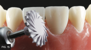 Dr. Chan article Predictable Results Anterior Composites - FIG 15