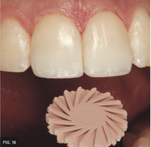 Dr. Chan article Predictable Results Anterior Composites - FIG 16