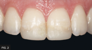 Dr. Chan article Predictable Results Anterior Composites - FIG 2