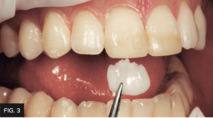 Dr. Chan article Predictable Results Anterior Composites - FIG 3