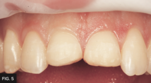 Dr. Chan article Predictable Results Anterior Composites - FIG 5