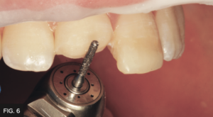 Dr. Chan article Predictable Results Anterior Composites - FIG 6