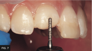 Dr. Chan article Predictable Results Anterior Composites - FIG 7