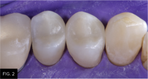 pre-polisher occlusal view