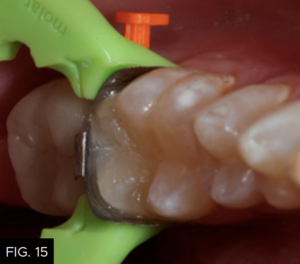 Optimizing-Aesthetics-Predictability-clinical FIG 15